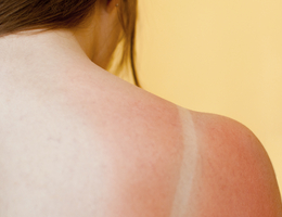A woman's sunburned shoulder.